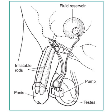 Diagram of a surgical implant to treat Erectile Dysfunction in male patients.