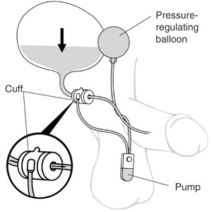 Diagram of Placement of an Artificial Sphincter