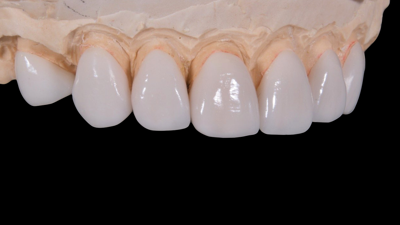 dental crowns