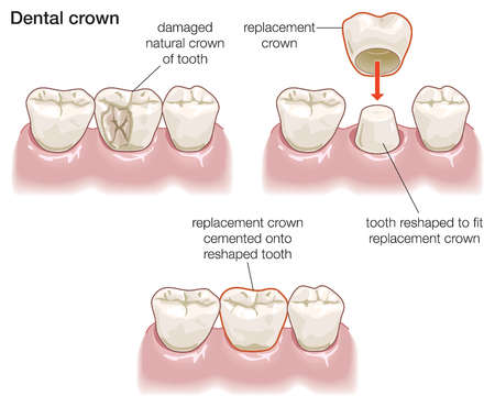 This image shows the process of getting a dental crown. First, the dentist removes the damaged part of the tooth. Then, the crown is placed over the reshaped tooth. Finally, the replacement crown is cemented onto the tooth.