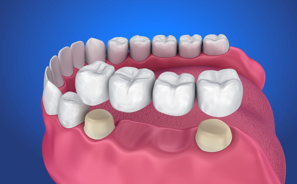 There are two missing teeth that will be replaced by pontics, the alternate teeth. They are attached via the two teeth on either side of the gaps.