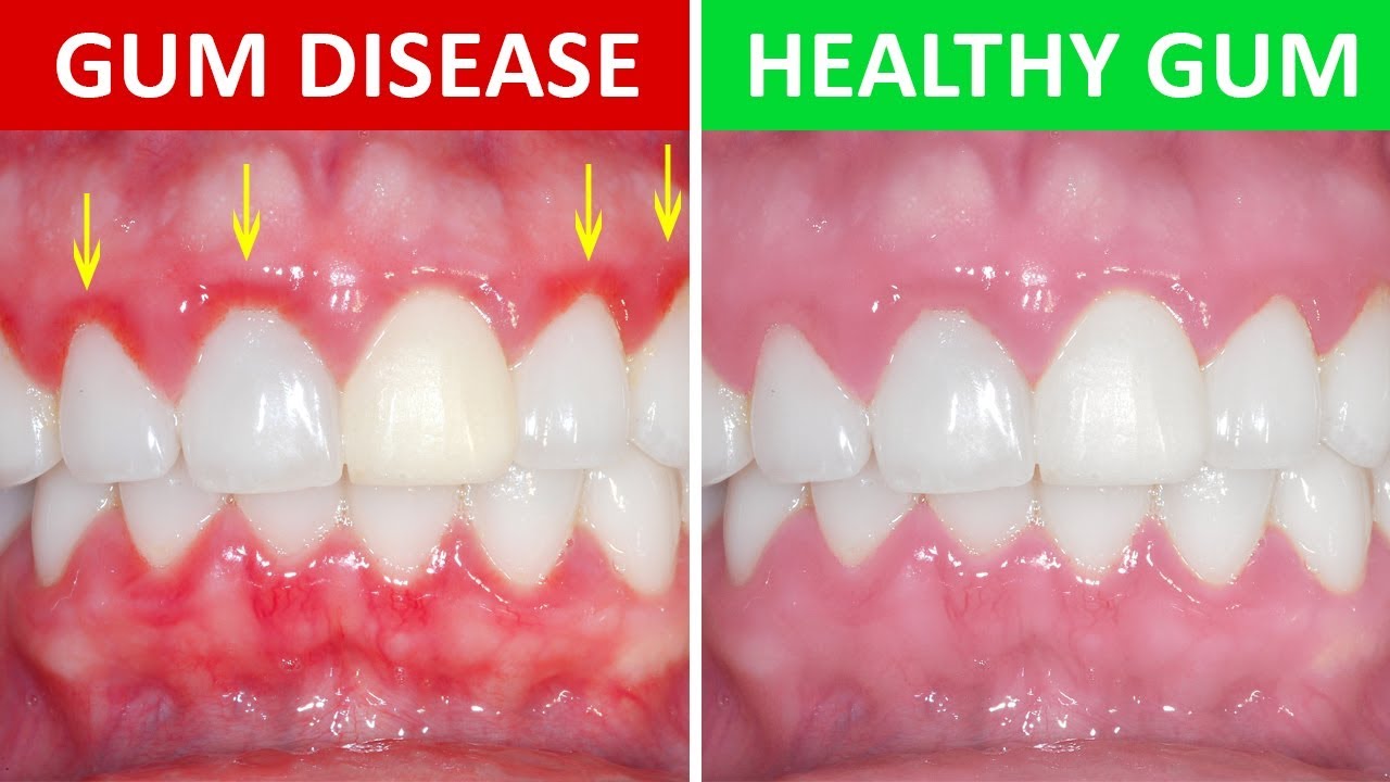 On the left side, someone's gums are shown, red and inflamed. On the right, the gums are pink and healthy.