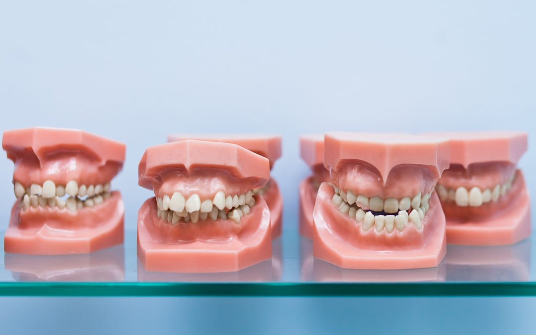 Four teeth models each show different overbites/teeth positions.