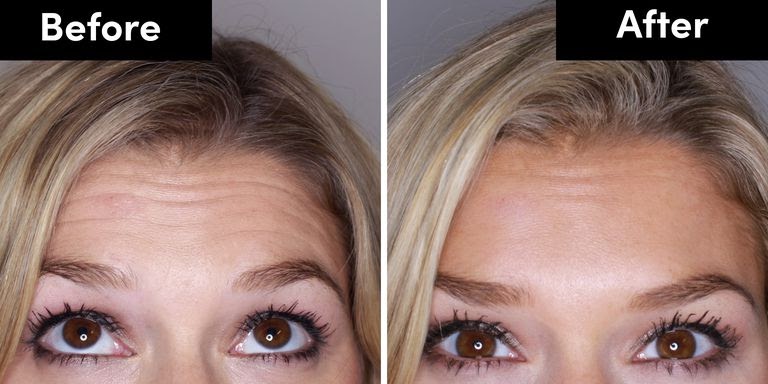 A before and after picture of a woman who received botox on her forehead.