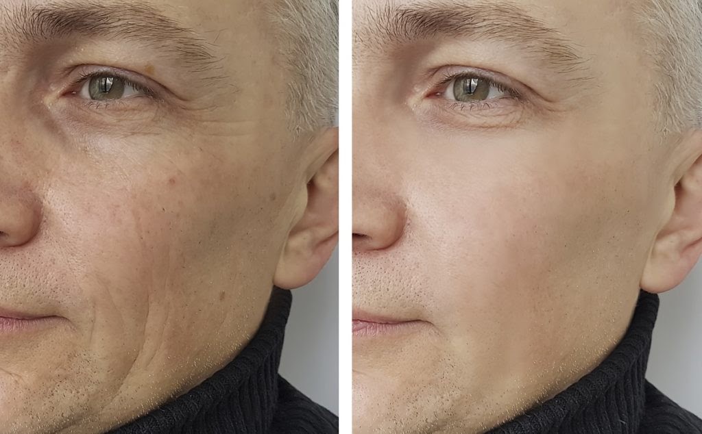 A before and after picture of an older man who received dermal fillers in his cheek.