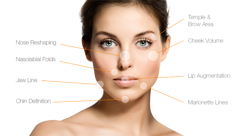 A diagram of a woman shows common places to receive dermal fillers.
