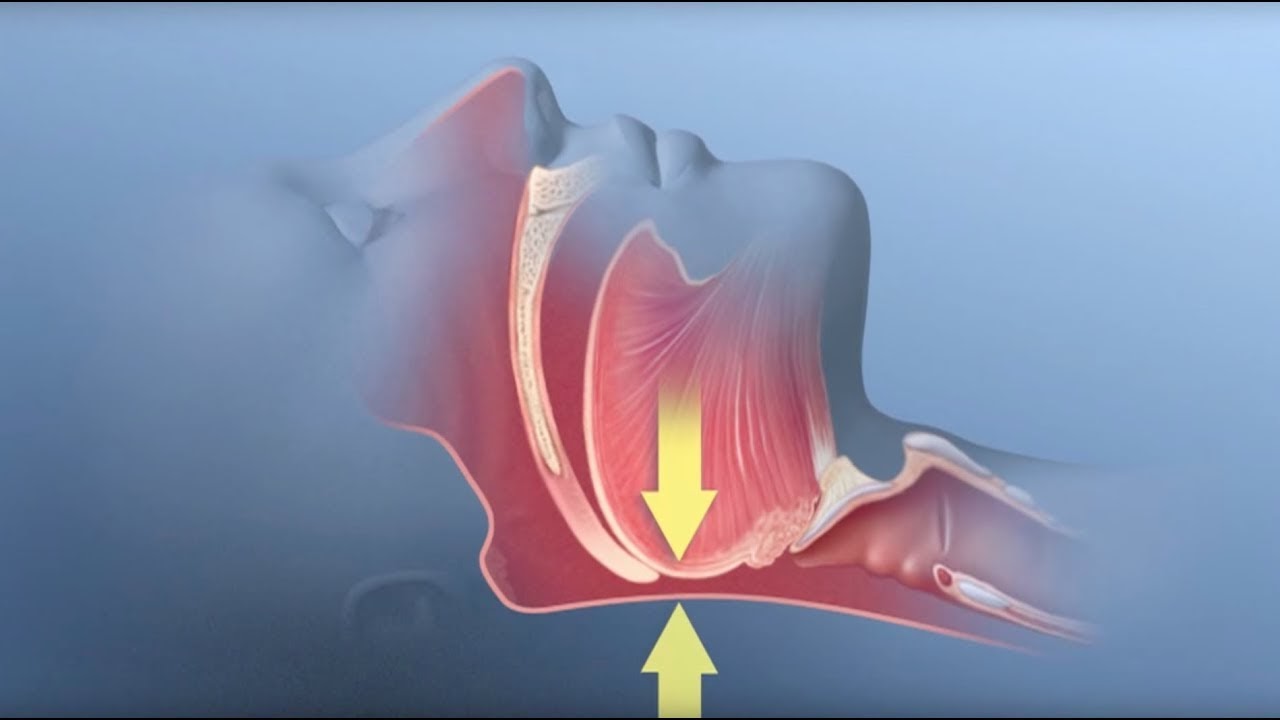 A blue and red diagram of a throat closing.