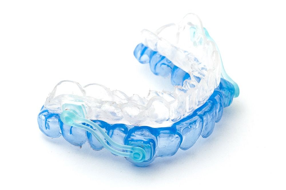 A blue and white plastic oral appliance for obstructive sleep apnea.