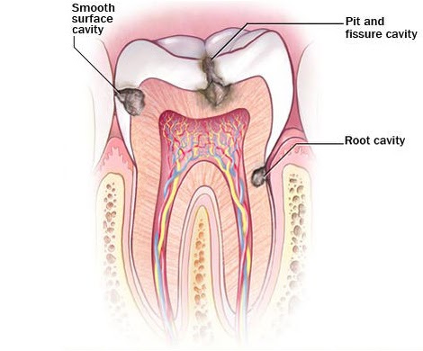 A diagram of a tooth's roots and different types of cavities.