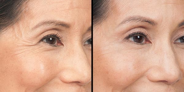 A before and after of a woman who received botox.