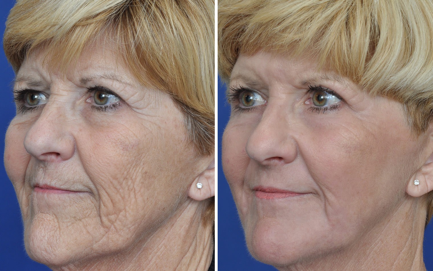 A before and after of an older lady who received laser resurfacing.