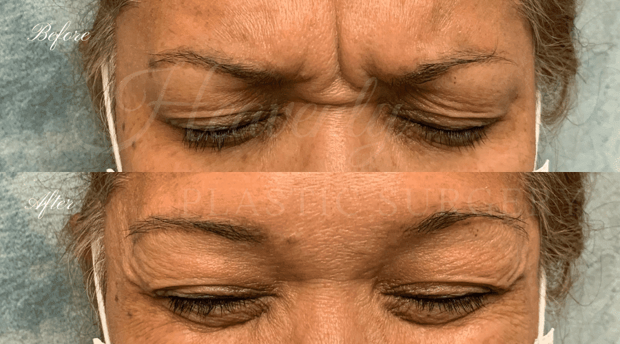 before and after images of a woman who received Botox in her forehead