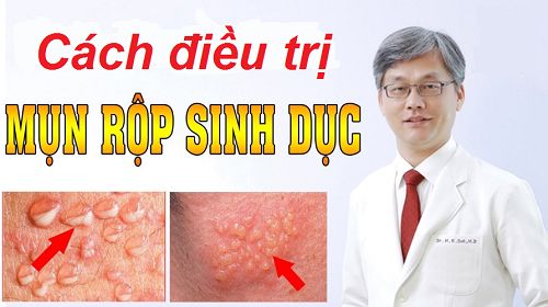 Cách điều trị mụn rộp sinh dục