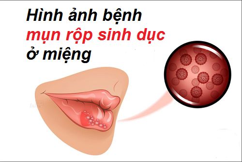 Hình ảnh Herpes sinh dục ở miệng