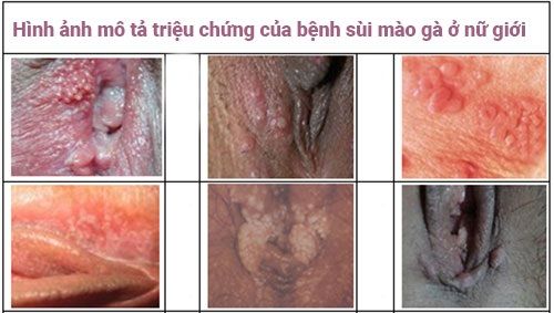 bệnh sùi mào gà ở phụ nữ