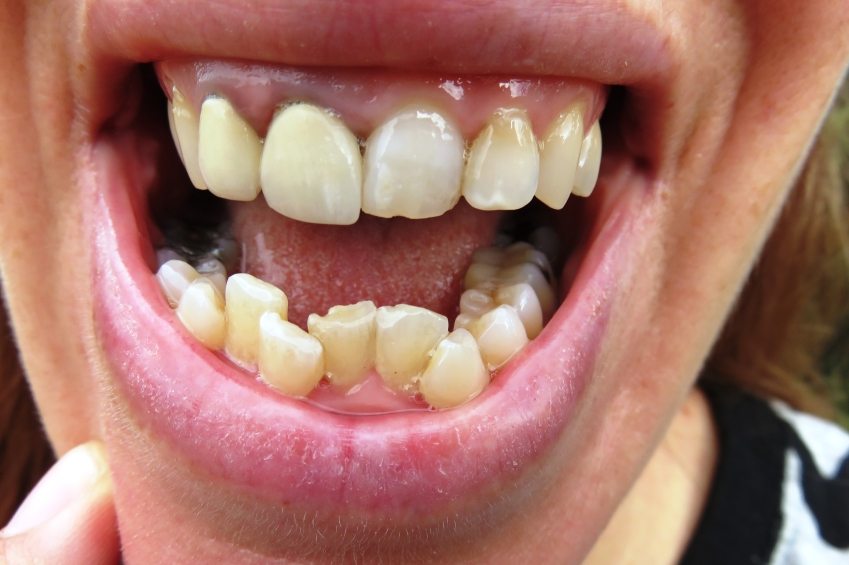 Image result for imperfect teeth