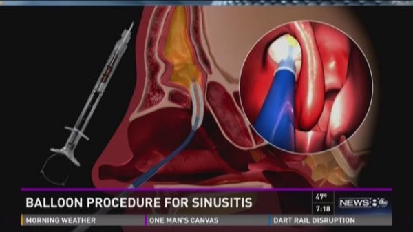 WFAA Interview with Dr. Rajiv Pandit on the Balloon Procedure for Sinusitis Patients