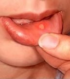 Canker sores are small, shallow ulcers on the tongue or inside the lips and cheeks.