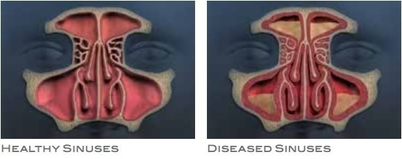 Healthy vs Diseased Sinuses