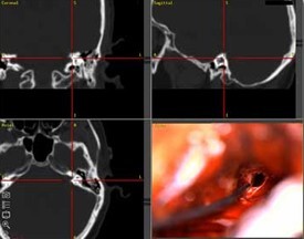 Image-guided surgery can help ENT surgeons create a plan for your surgery.