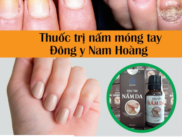 Móng tay bị nấm nguyên nhân do đâu và Cách trị tận gốc bằng giấm táo | Blog
