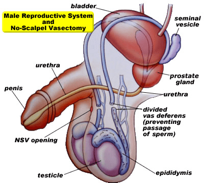 Vasectomy option for family birth control.