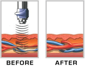 How Treatment for ED using Low Intensity Shock Wave Therapy works