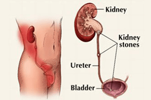 Kidney Stone Diagram