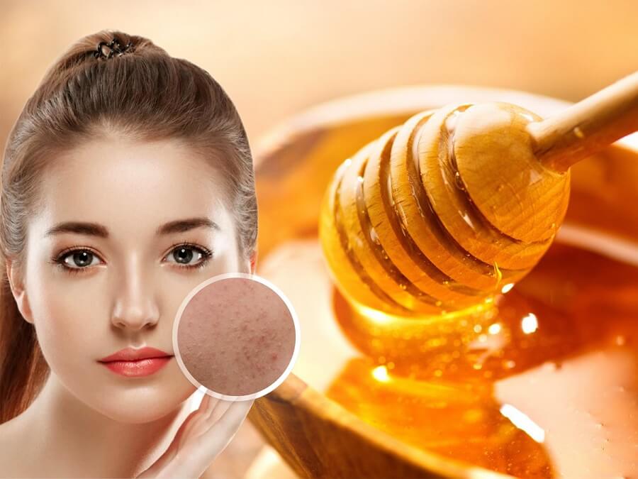 Mật ong giúp trị mụn và làm sạch da hiệu quả