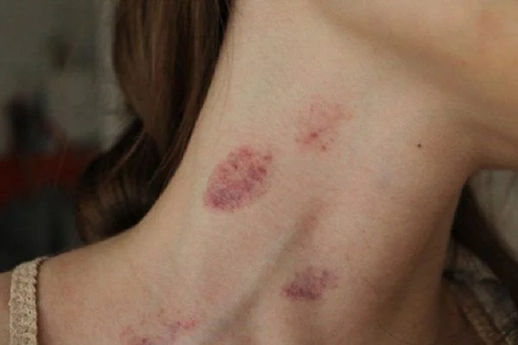 Hickey là những dấu hôn thể hiện tình cảm của các cặp đôi