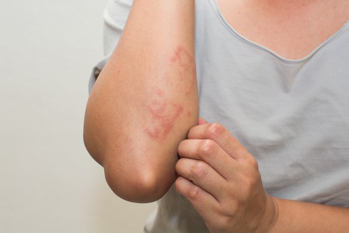 dấu hiệu nhiễm HIV