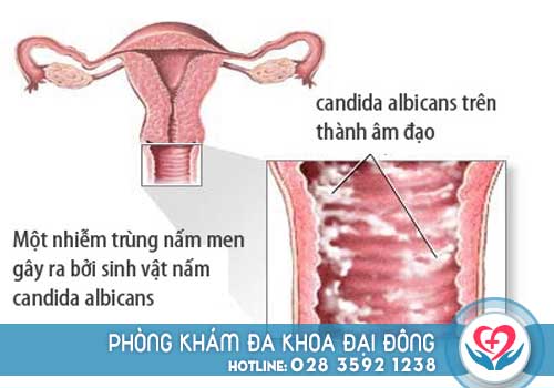 Hình ảnh viêm âm đạo do nấm candida gây ra