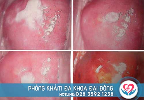 Hình ảnh âm đạo bị sưng đỏ do viêm nhiễm