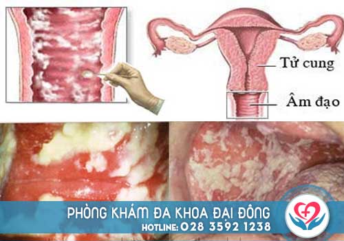 Hình ảnh bệnh viêm âm đạo mức độ nặng