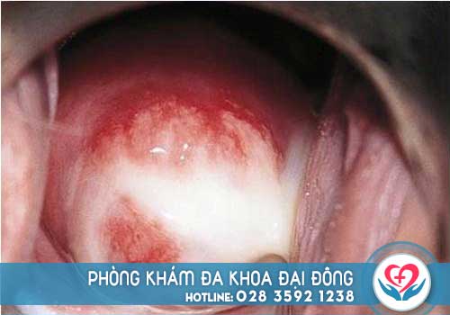 Hình ảnh viêm âm đạo do khí hư gây ra