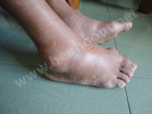 Hình ảnh bệnh gout