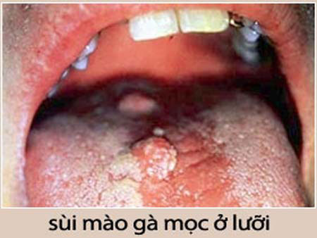 hinh-anh-benh-sui-mao-ga-o-mieng-2