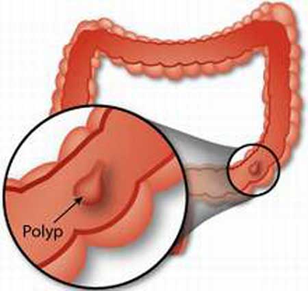 polyp-truc-trang