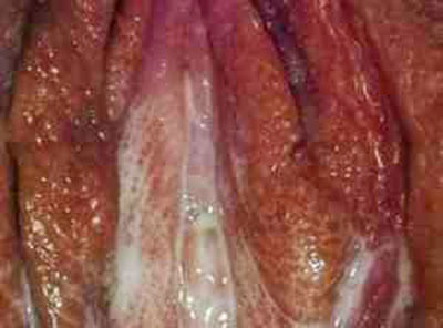 hinh-anh-benh-lau-o-nu-gioi