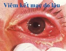 hinh-anh-benh-lau-o-mat
