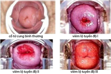 trieu-chung-viem-lo-tuyen-co-tu-cung