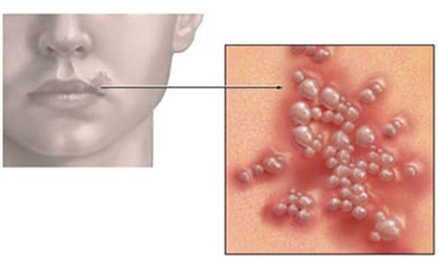 HIV-va-nhung-bieu-hien-thuong-gap-3