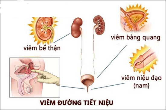 Triệu chứng viêm đường tiết niệu nam