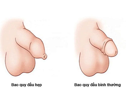 Cách lộn bao quy đầu