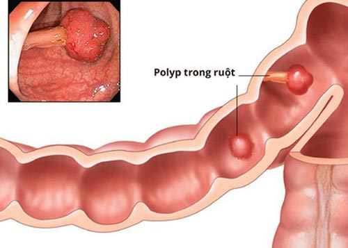 Polyp trực tràng