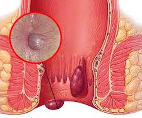 Triệu chứng của bệnh trĩ