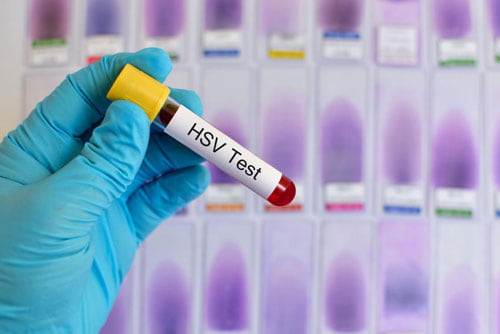 Xét nghiệm hsv ở đâu tốt hà nội