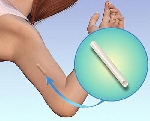 Chi phí cấy que tránh thai hết bao nhiêu tiền