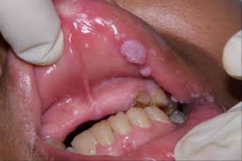 Hình ảnh bệnh sùi mào gà ở miệng