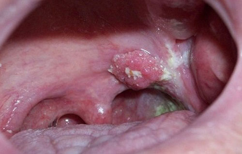 Hình ảnh sùi mào gà ở miệng